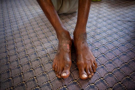 The feet of a man tortured for months by Obama's freedom fighters on suspicion that he was a Gaddafi supporter.
