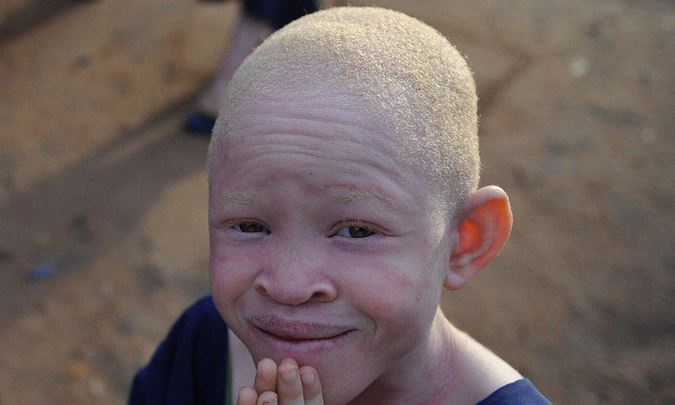 albino
