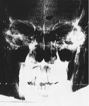XRAY 1